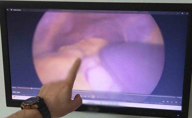 Samsun'da organları ters yerleşen 54 yaşındaki Muzaffer Uzunbacak kitleden kurtuldu